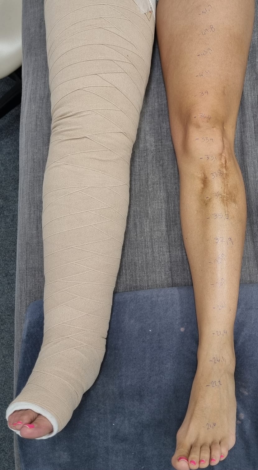 Lymphoedema